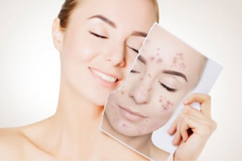 Как справляться с угревой сыпью